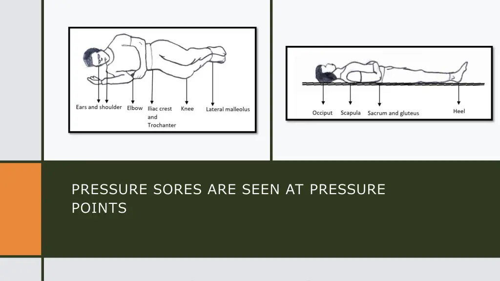 pressure sores are seen at pressure points