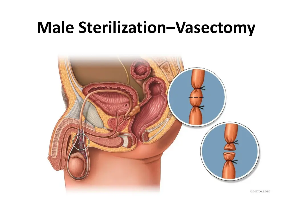 male sterilization vasectomy 1