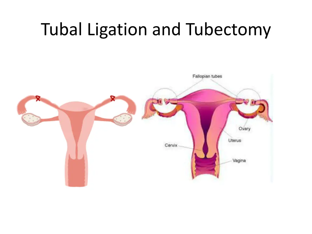 tubal ligation and tubectomy