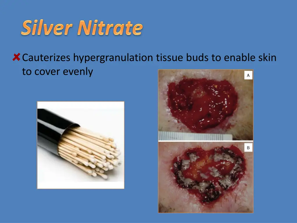 cauterizes hypergranulation tissue buds to enable