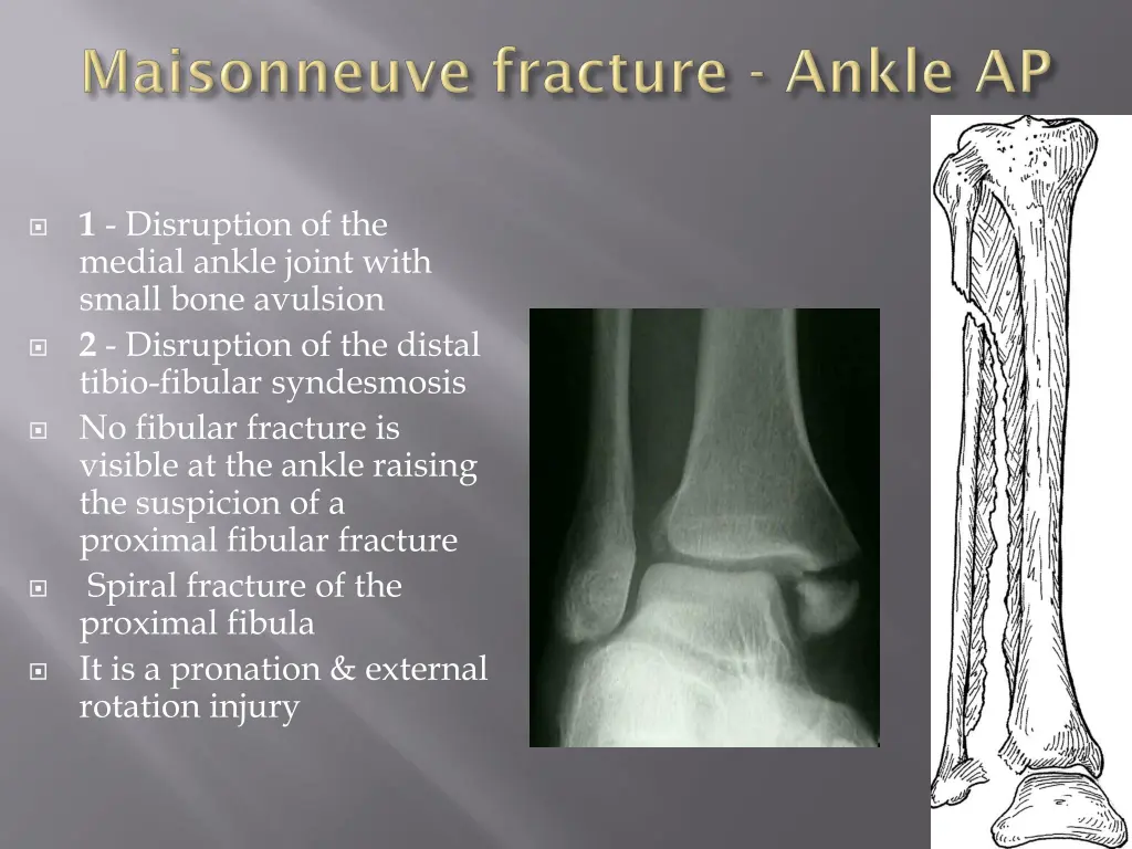 1 disruption of the medial ankle joint with small