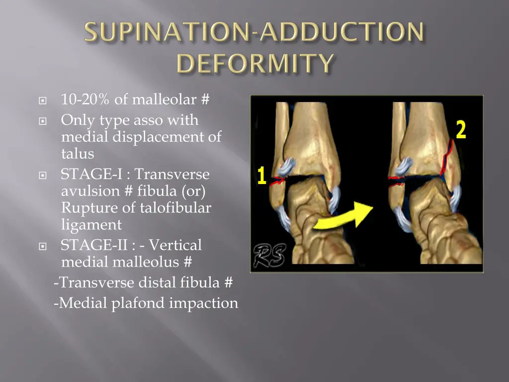 10 20 of malleolar only type asso with medial