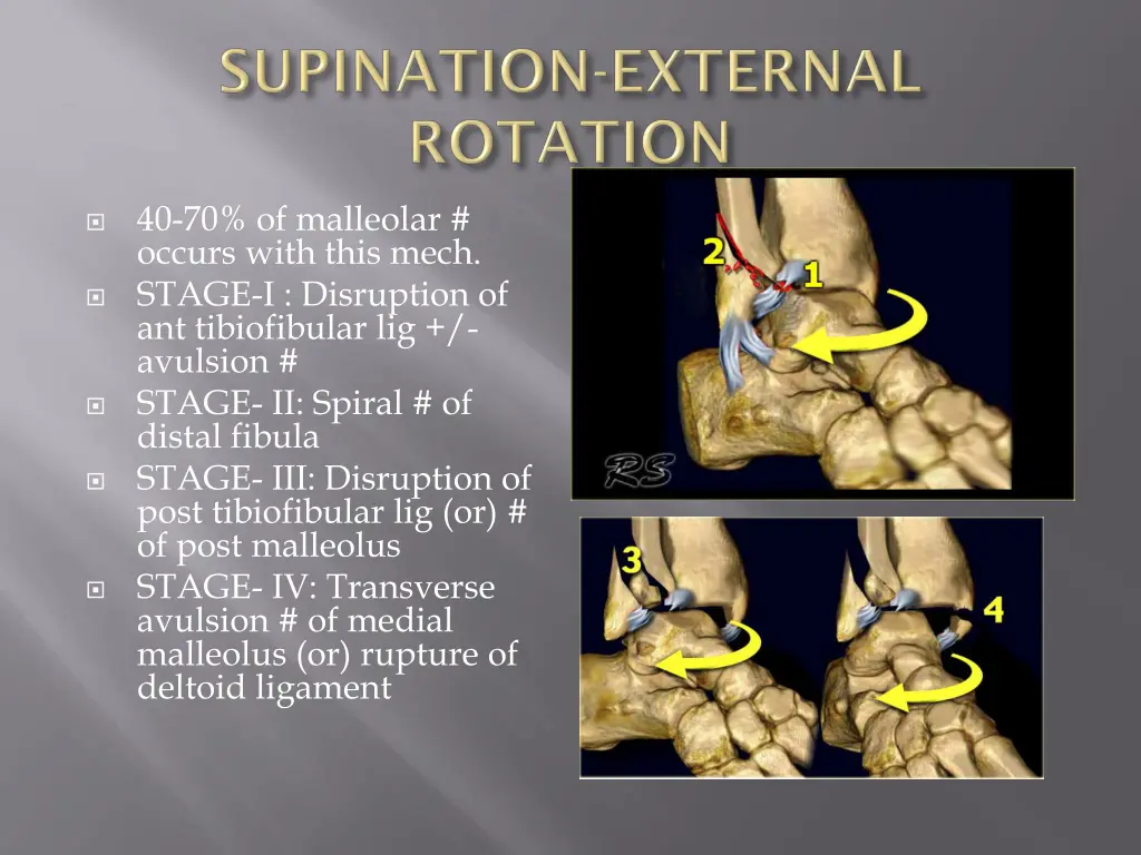 40 70 of malleolar occurs with this mech stage