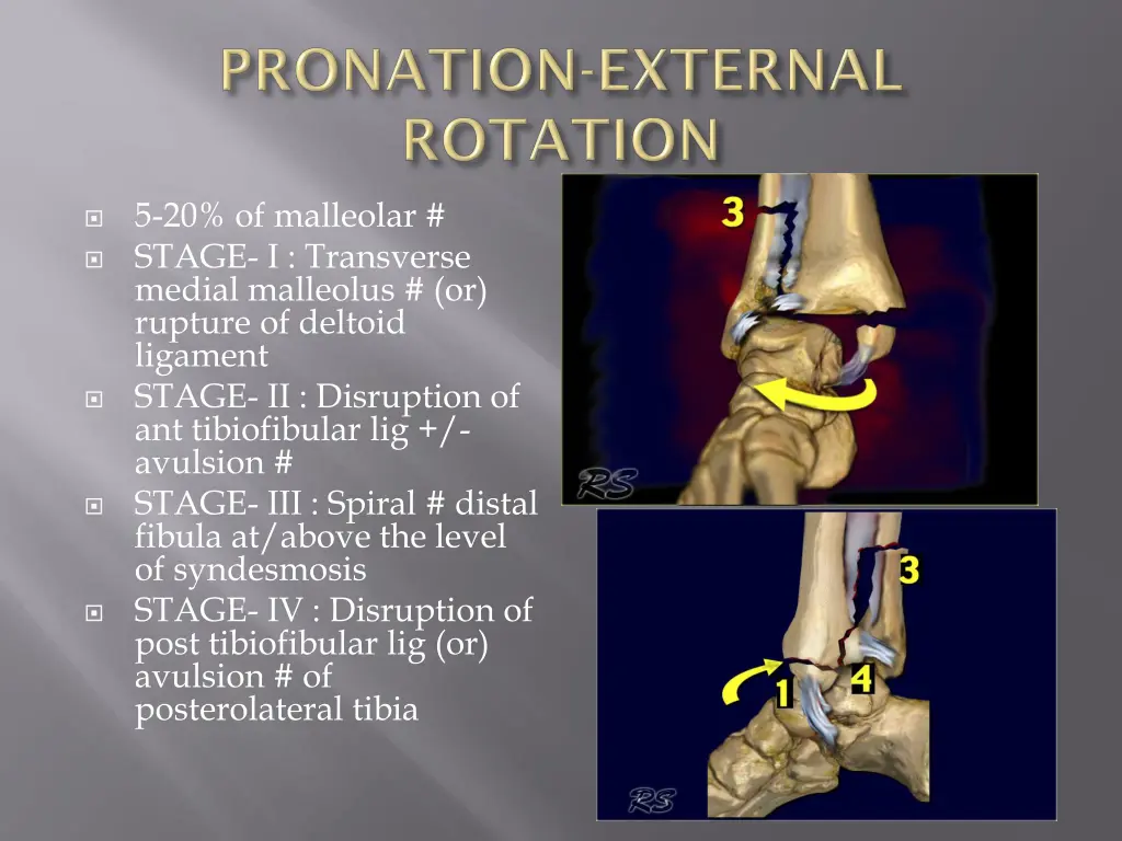 5 20 of malleolar stage i transverse medial