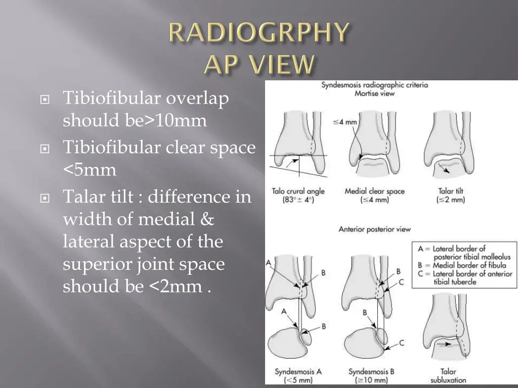 tibiofibular overlap should be 10mm tibiofibular