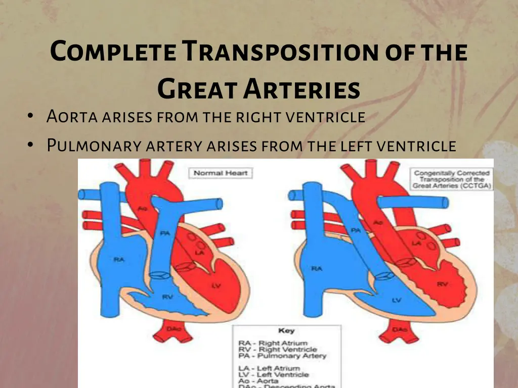 complete transposition of the great arteries 1