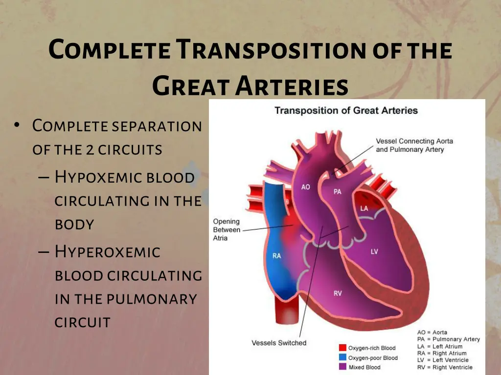 complete transposition of the great arteries 2