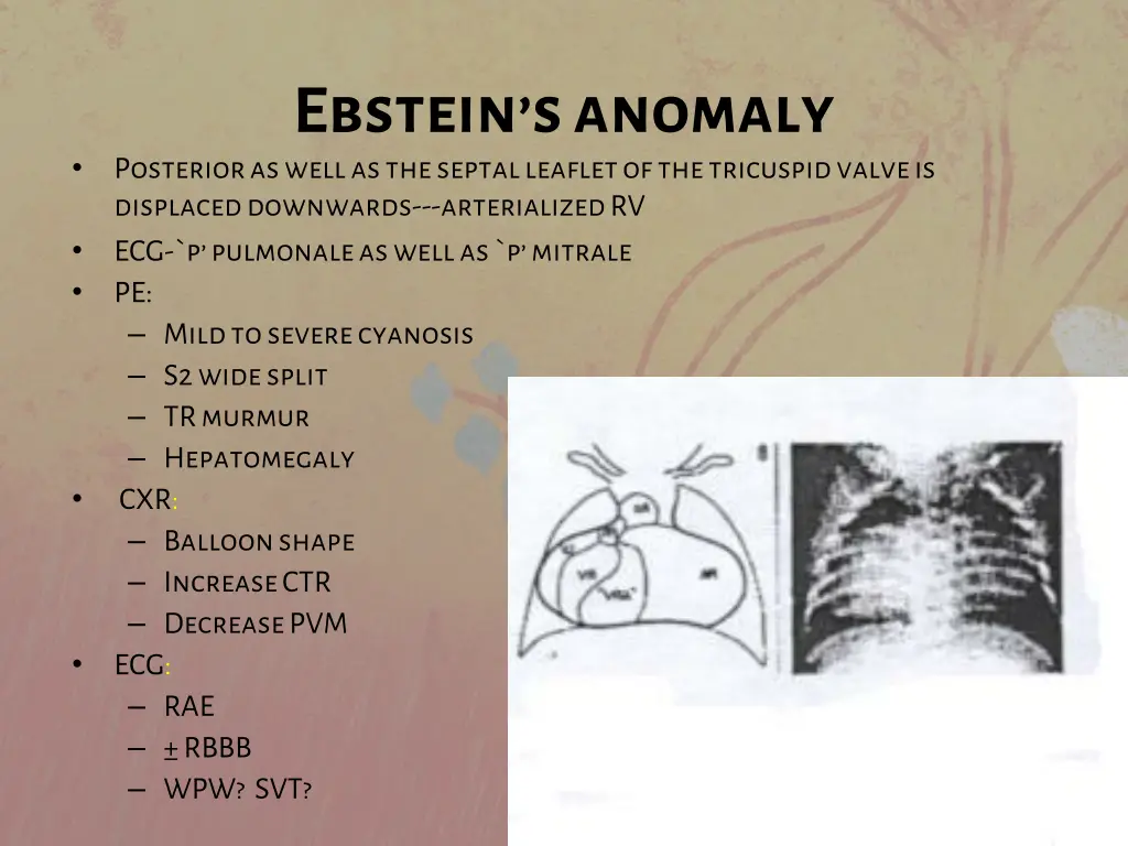 ebstein s anomaly posterior as well as the septal