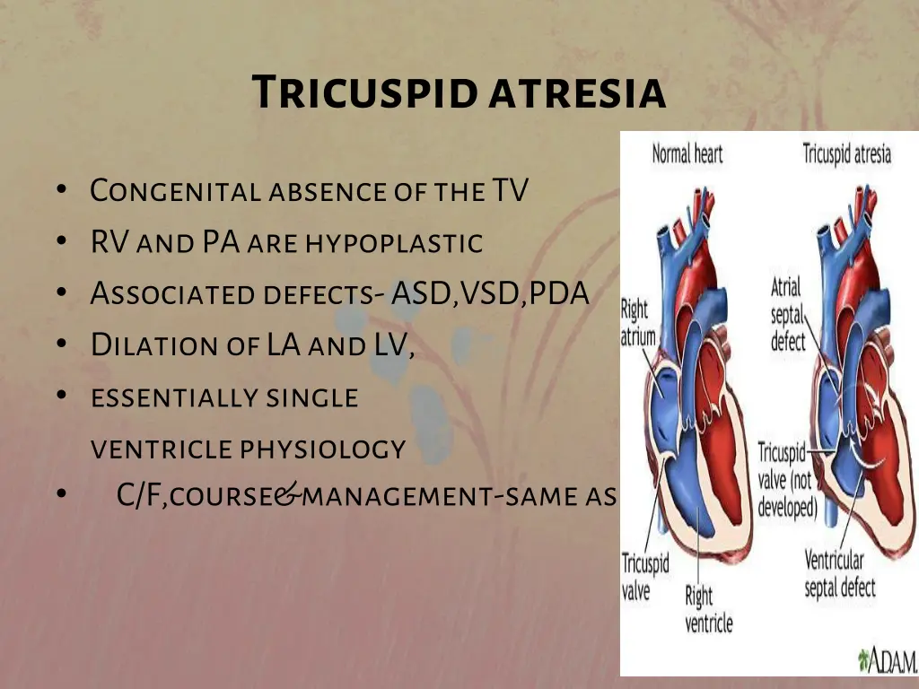 t ricuspid atresia