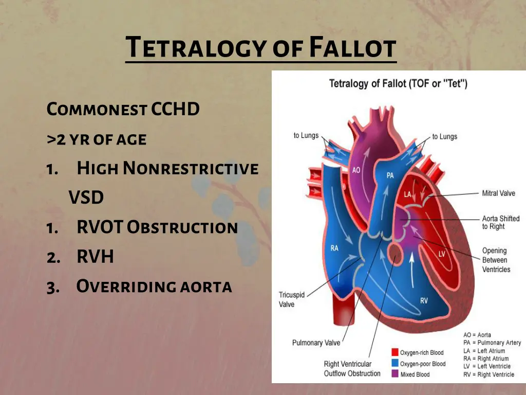 tetralogy of fallot