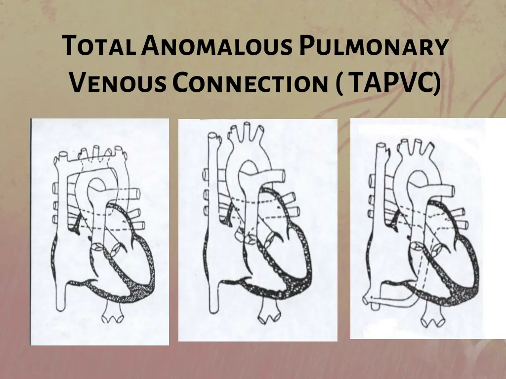 total anomalous pulmonary venous connection tapvc