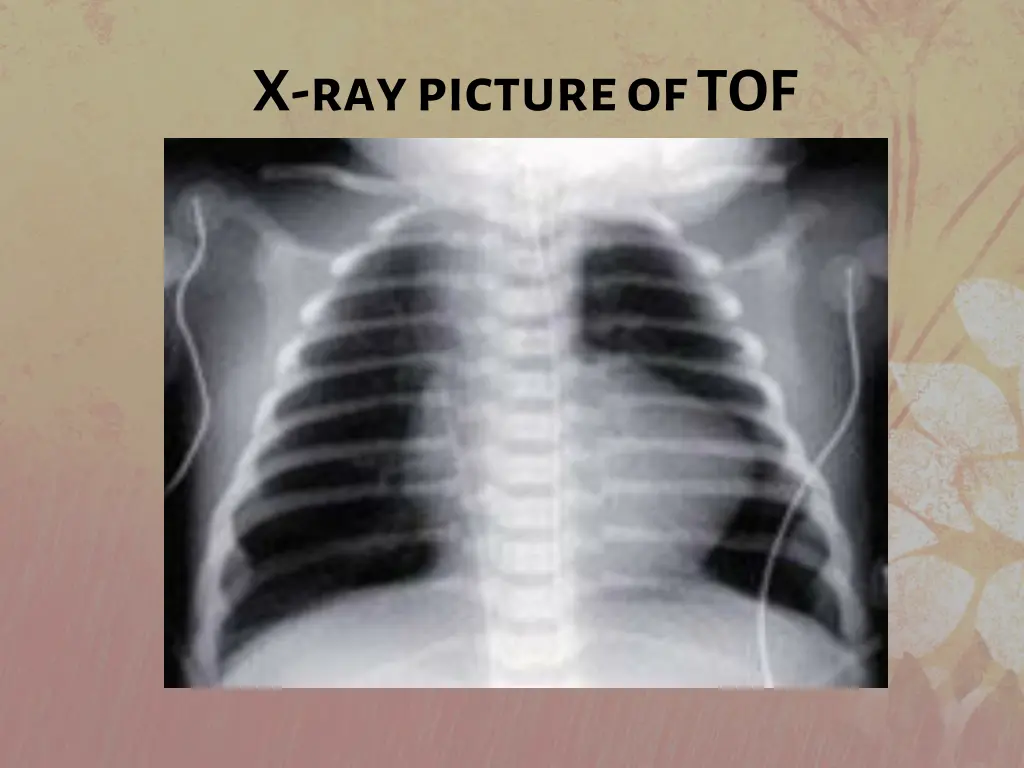 x ray picture of tof