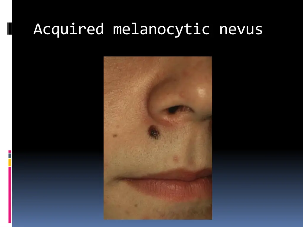 acquired melanocytic nevus