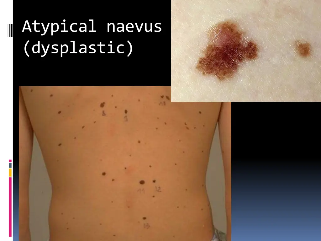 atypical naevus dysplastic