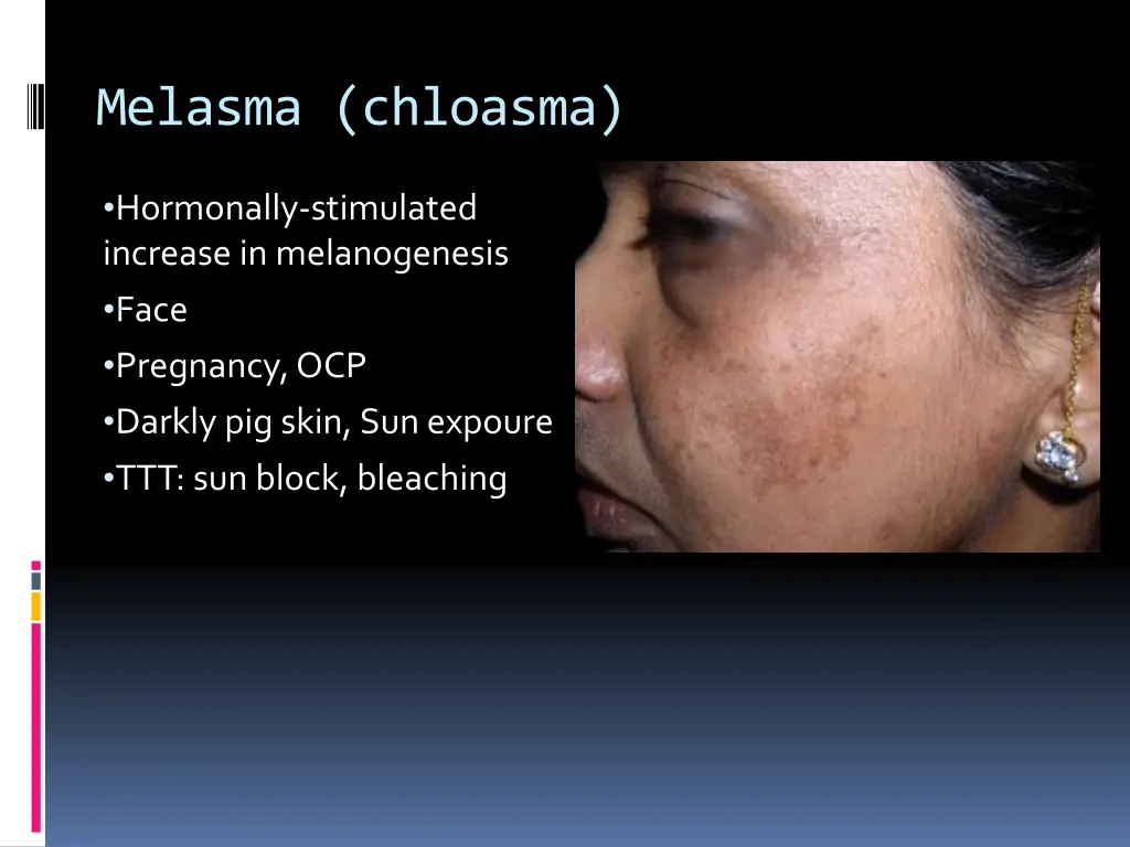 melasma chloasma