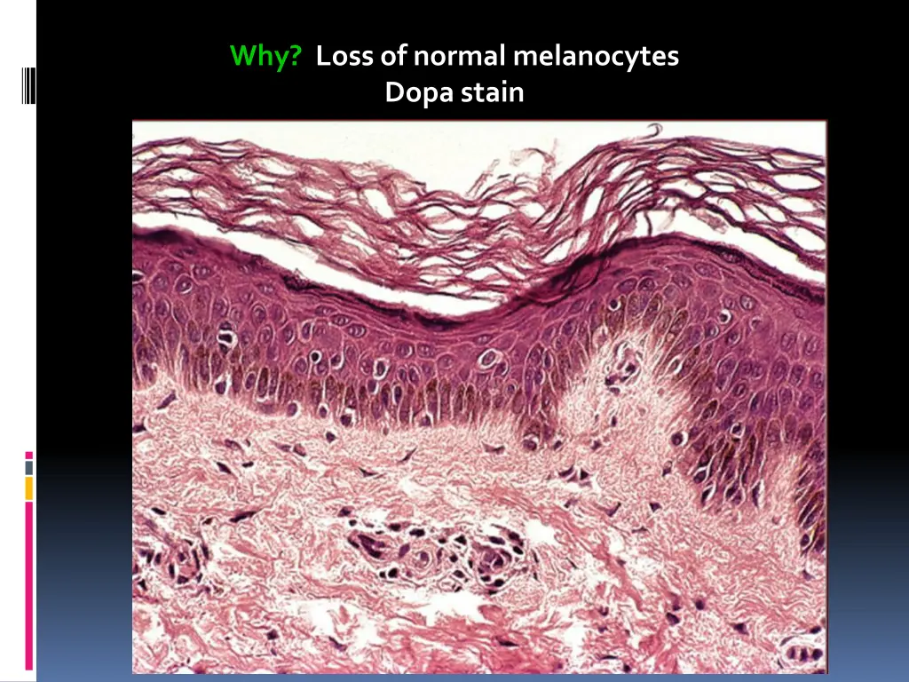 why loss of normal melanocytes dopa stain