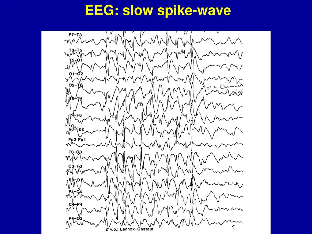 eeg slow spike wave