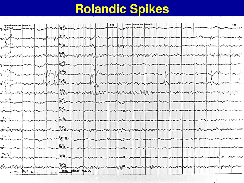 rolandic spikes