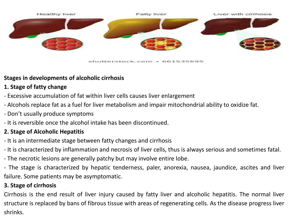 stages in developments of alcoholic cirrhosis