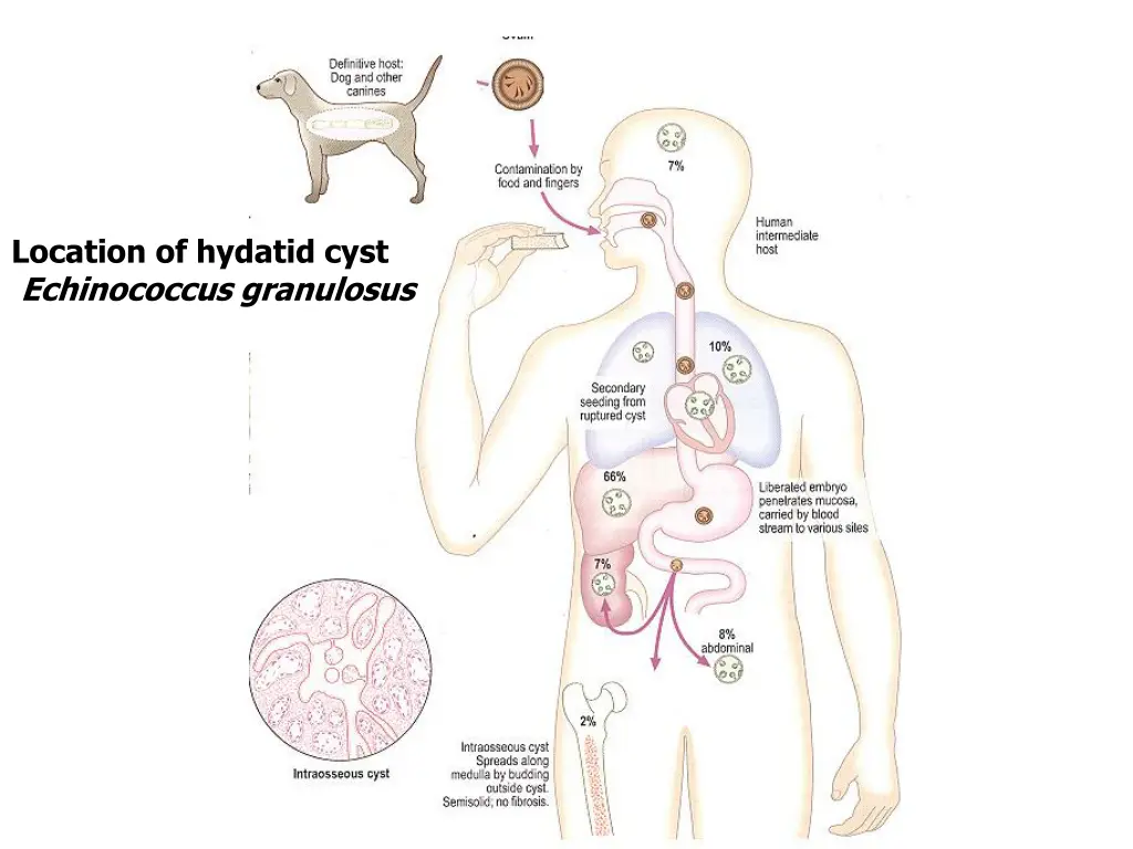 location of hydatid cyst echinococcus granulosus