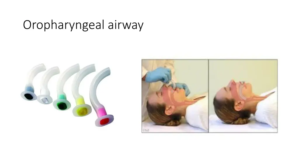 oropharyngeal airway