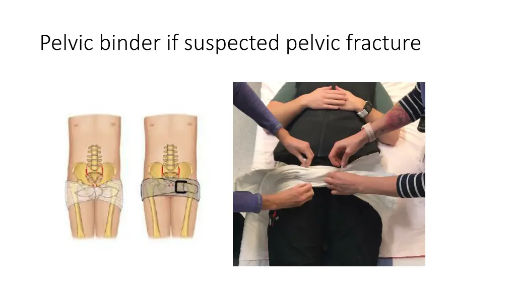 pelvic binder if suspected pelvic fracture