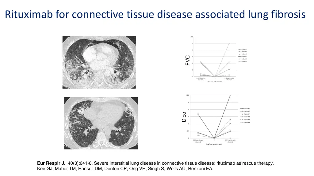 rituximab for connective tissue disease