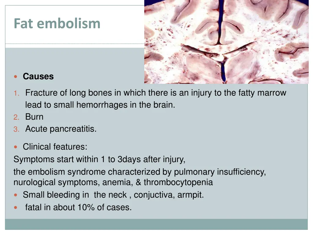 fat embolism