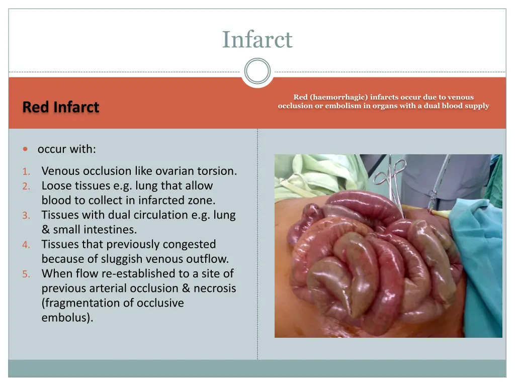 infarct 1