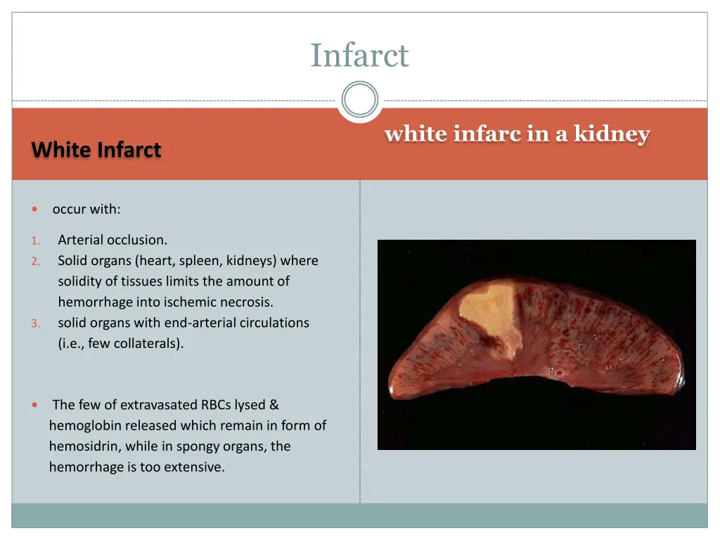 infarct