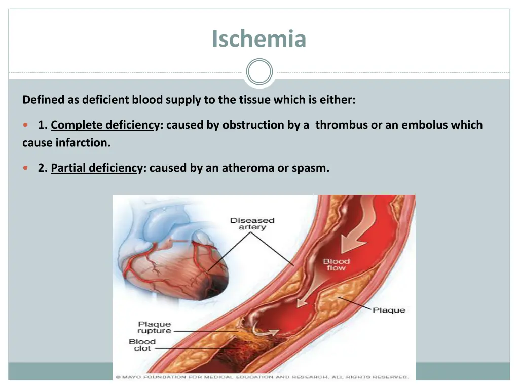 ischemia