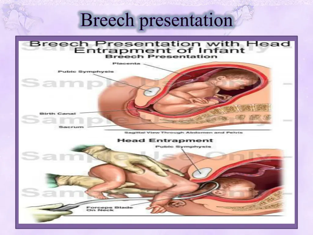 breech presentation