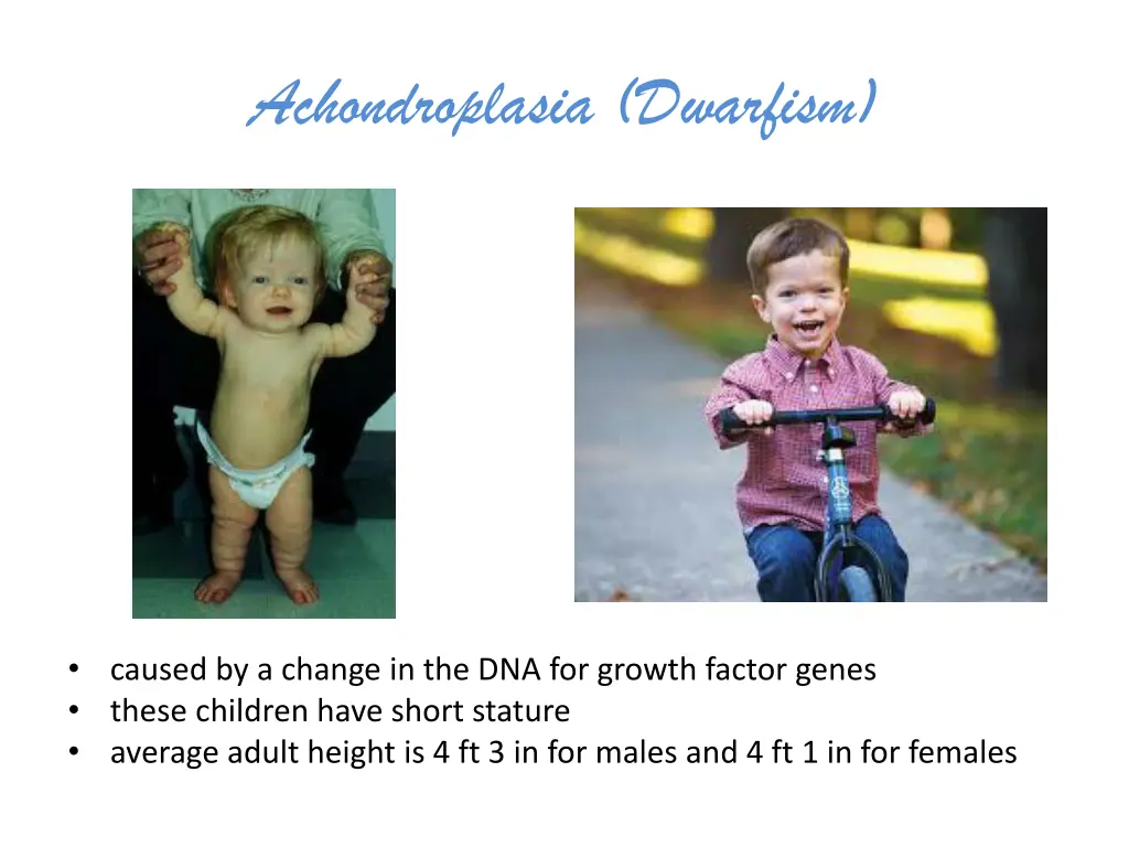 achondroplasia dwarfism