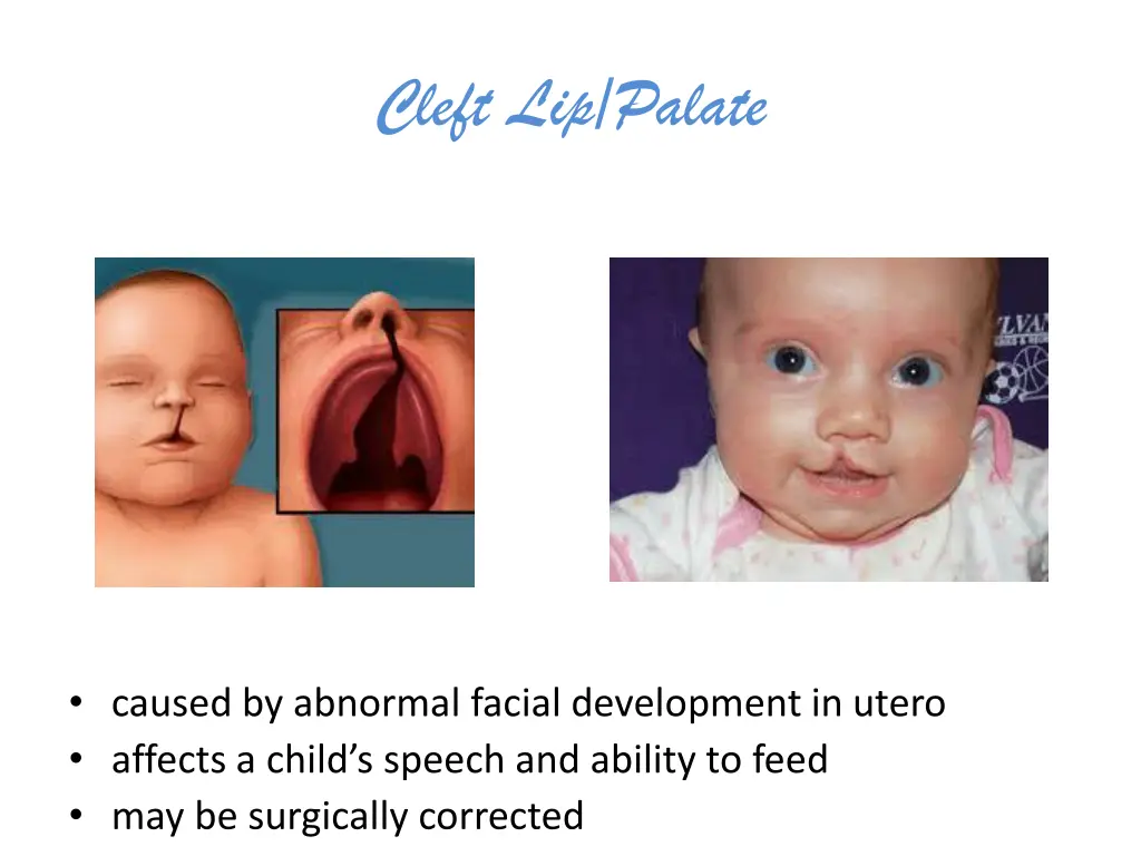 cleft lip palate