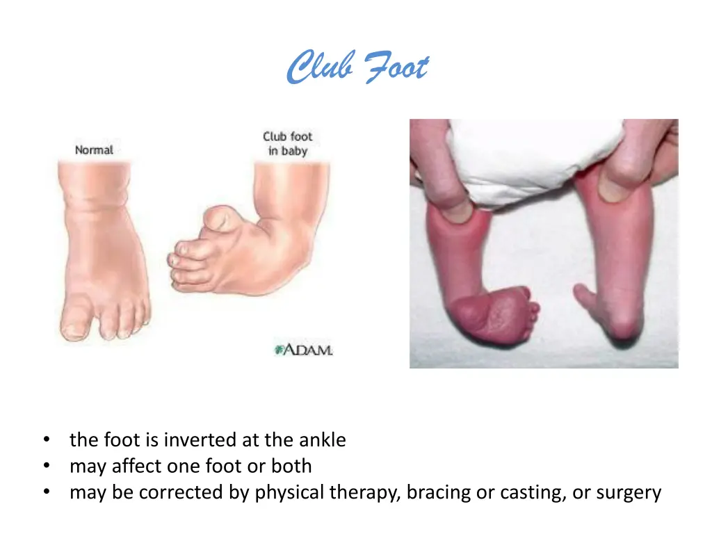 club foot