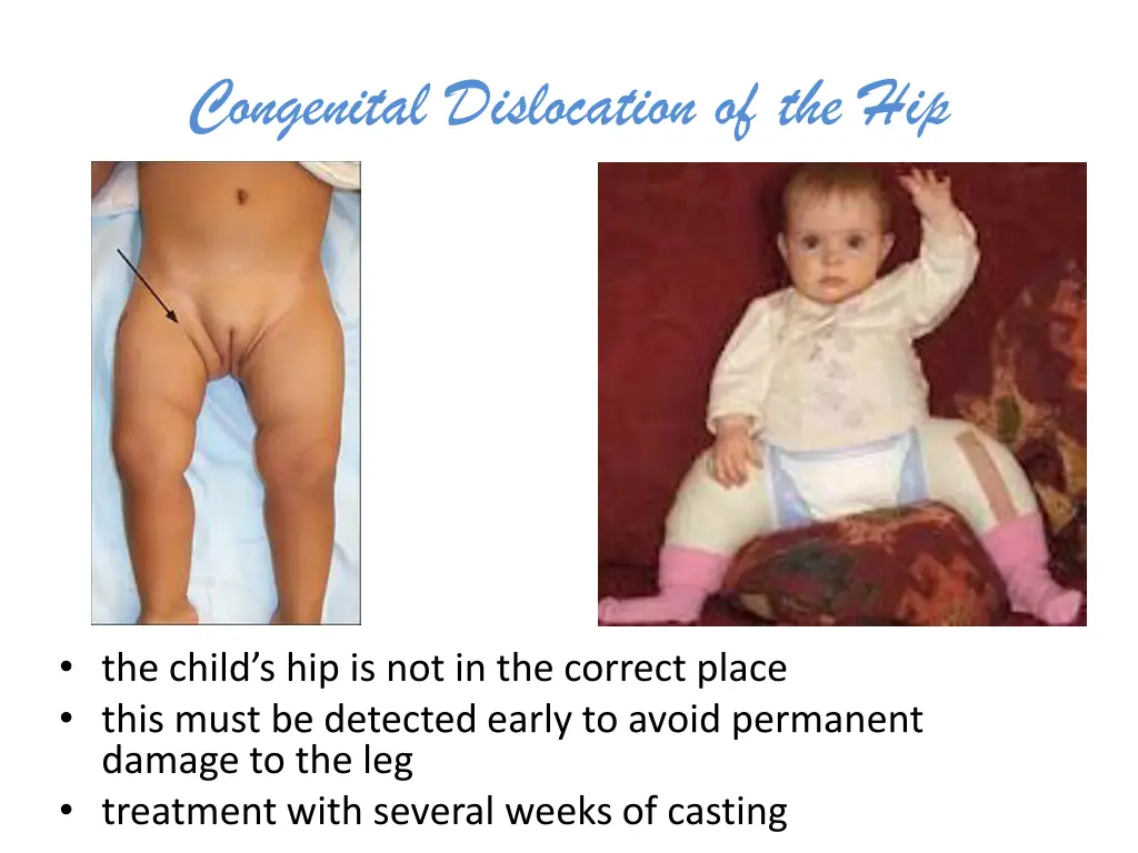 congenital dislocation of the hip