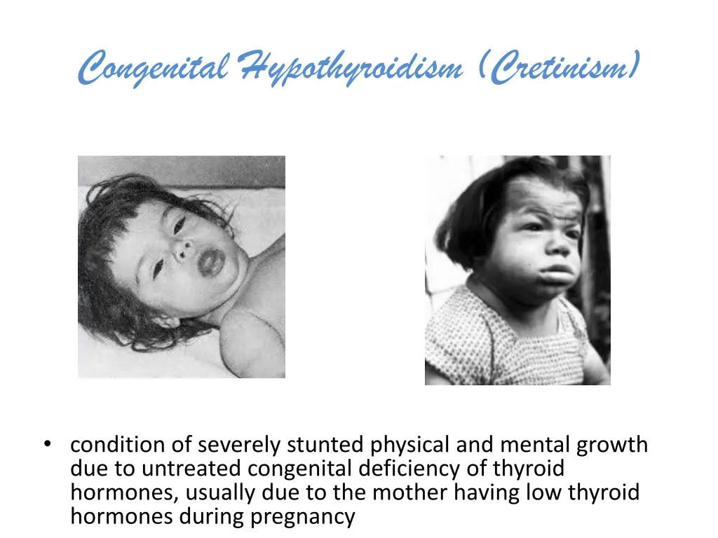 congenital hypothyroidism cretinism