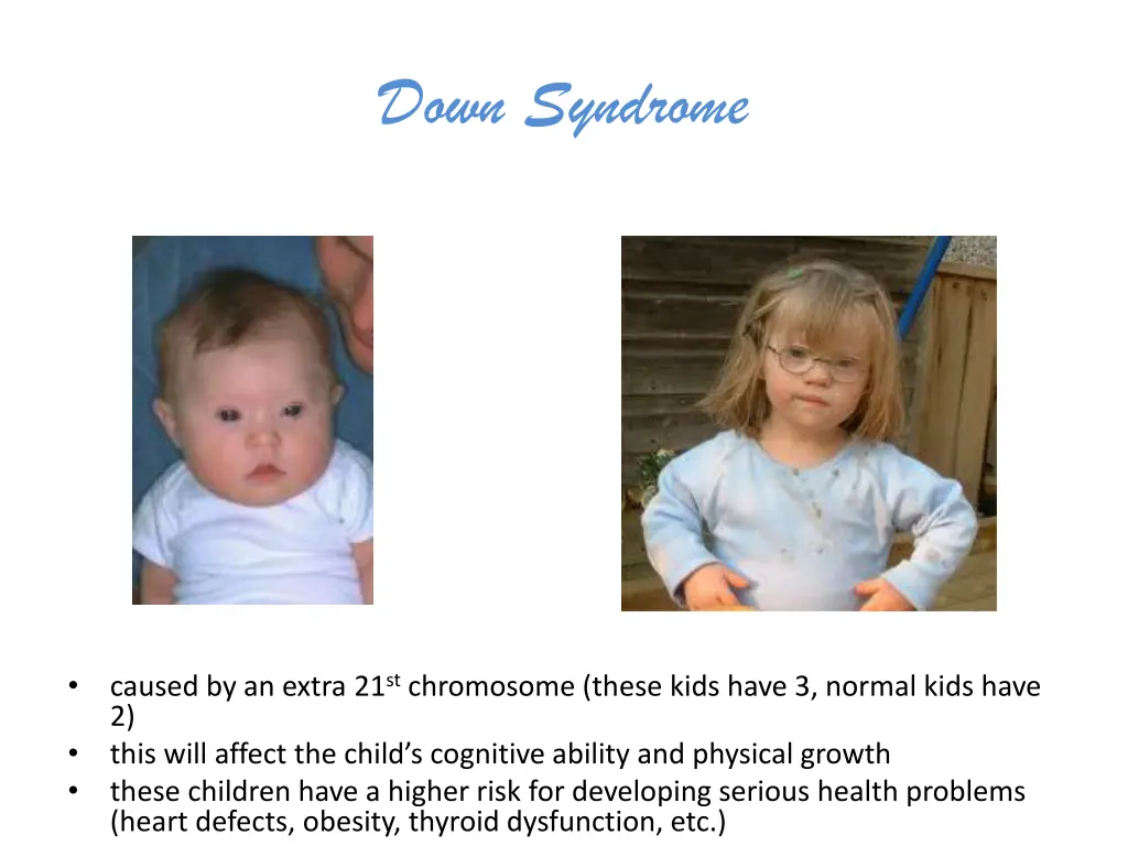 down syndrome