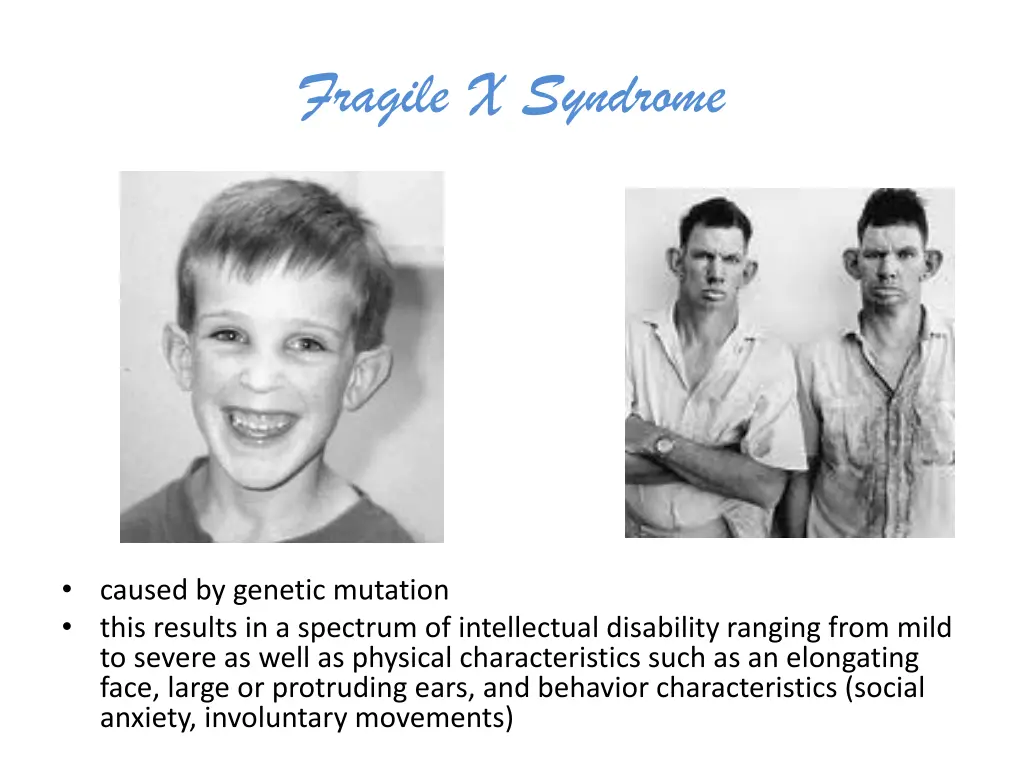 fragile x syndrome