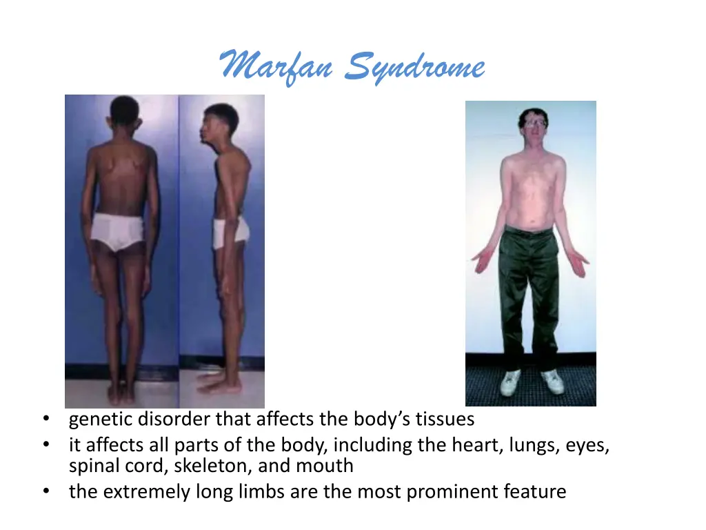 marfan syndrome