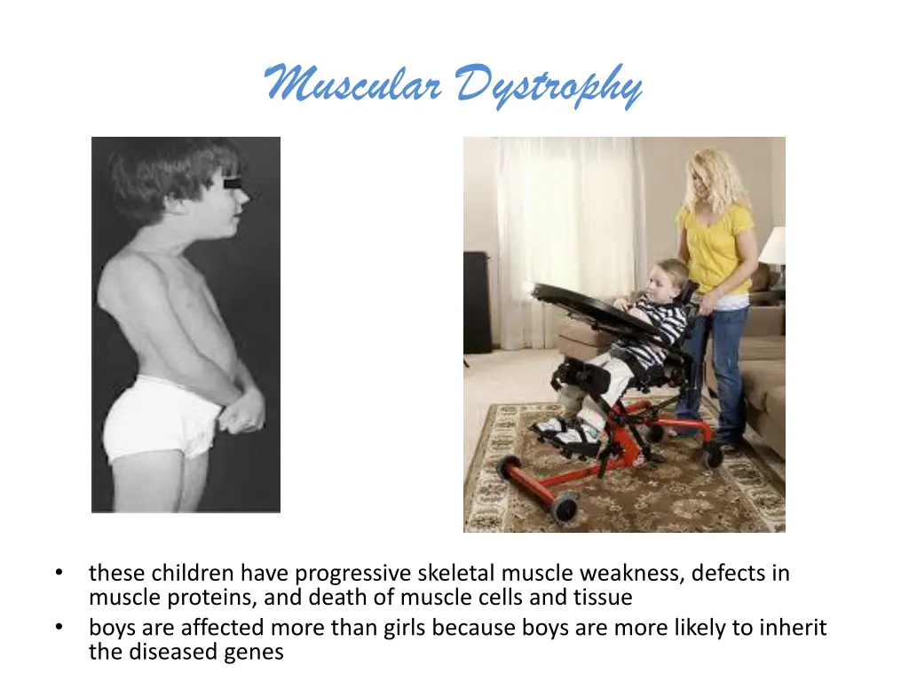 muscular dystrophy