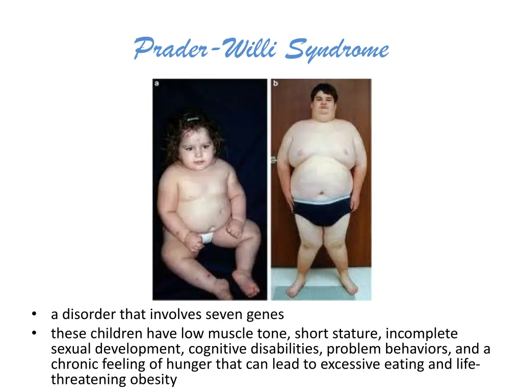 prader willi syndrome