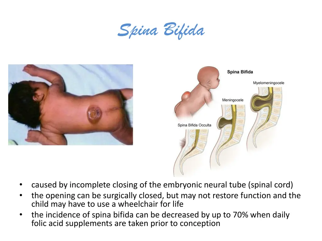 spina bifida