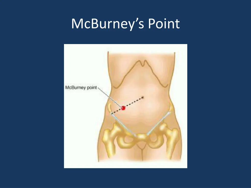 mcburney s point