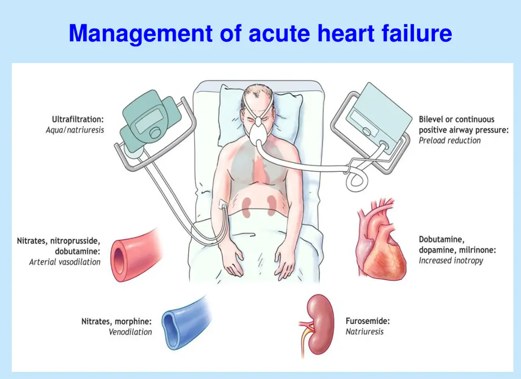 management of acute heart failure