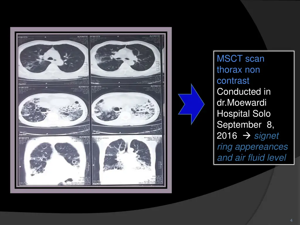 msct scan thorax non contrast conducted