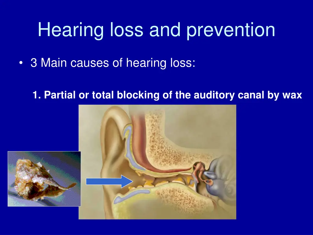 hearing loss and prevention