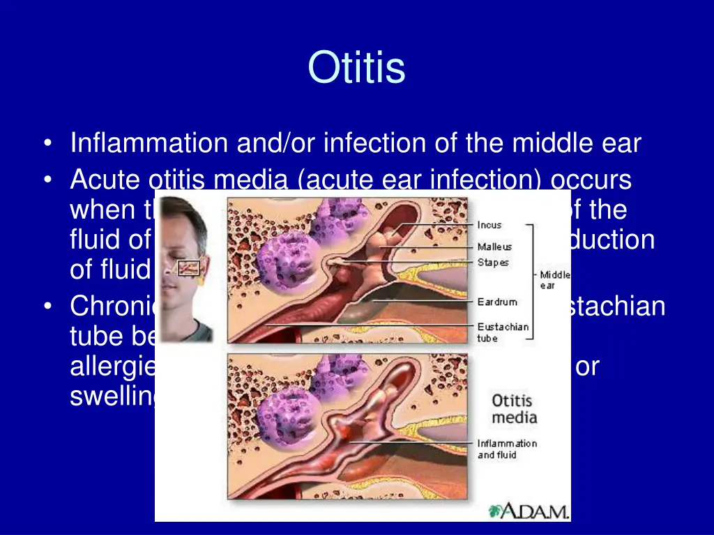 otitis