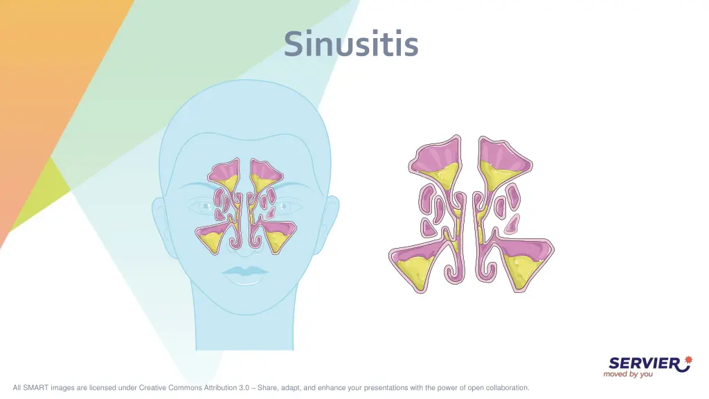 sinusitis