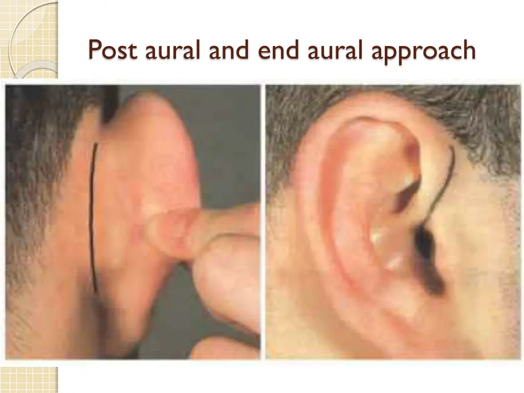 post aural and end aural approach